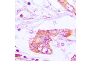 Immunohistochemical analysis of Apolipoprotein E staining in human lung cancer formalin fixed paraffin embedded tissue section. (APOE antibody  (Center))