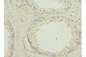 Immunohistochemistry of paraffin-embedded human prostate cancer using ABIN7154206 at dilution of 1:100 (PYGB antibody  (AA 6-843))