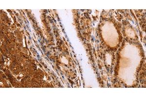Immunohistochemistry of paraffin-embedded Human thyroid cancer tissue using SLC9A3R2 Polyclonal Antibody at dilution 1:40 (SLC9A3R2 antibody)