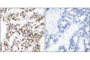 Immunohistochemistry analysis of paraffin-embedded human breast carcinoma tissue, using MYC (Ab-58) Antibody. (c-MYC antibody  (AA 25-74))