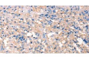 Immunohistochemistry of paraffin-embedded Human thyroid cancer using PRPS1/2/PRPS1L1 Polyclonal Antibody at dilution of 1:30 (PRPS1/2/1L1 antibody)