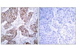 Immunohistochemical analysis of paraffin- embedded human breast carcinoma tissue using (EGFR antibody  (pTyr1092))
