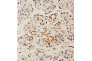 Anti-HOXA3 antibody, IHC(P) IHC(P): Human Pancreatic Cancer Tissue (HOXA3 antibody  (C-Term))