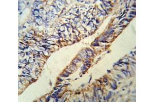 Anti-PCSK9 antibody IHC analysis in formalin fixed and paraffin embedded human colon carcinoma. (PCSK9 antibody  (AA 479-508))