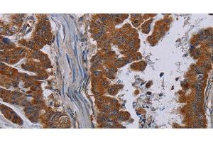 Immunohistochemistry of paraffin-embedded Human esophagus cancer tissue using NECTIN3 Polyclonal Antibody at dilution 1:40 (nectin-3 antibody)