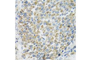 Immunohistochemistry of paraffin-embedded human lung cancer using TXN2 antibody (ABIN2560616) at dilution of 1:100 (40x lens). (TXN2 antibody)