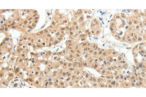 Immunohistochemistry of paraffin-embedded Human lung cancer tissue using PAX7 Polyclonal Antibody at dilution 1:35 (PAX7 antibody)