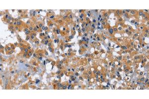Immunohistochemistry of paraffin-embedded Human thyroid cancer using IL2RB Polyclonal Antibody at dilution of 1:30 (IL2 Receptor beta antibody)
