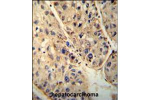 ABCD1 antibody immunohistochemistry analysis in formalin fixed and paraffin embedded human hepatocarcinoma followed by peroxidase conjugation of the secondary antibody and DAB staining. (ABCD1 antibody  (AA 257-285))
