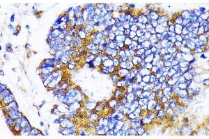 Immunohistochemistry of paraffin-embedded Human colon carcinoma using MRPL13 Polyclonal Antibody at dilution of 1:100 (40x lens). (MRPL13 antibody)