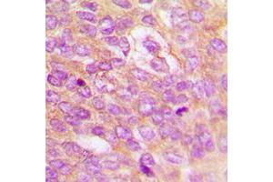Immunohistochemical analysis of IKK beta (pY199) staining in human breast cancer formalin fixed paraffin embedded tissue section.