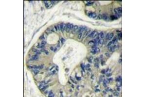 Formalin-fixed and paraffin-embedded human colon carcinoma reacted with AKT2 Antibody (N-term), which was peroxidase-conjugated to the secondary antibody, followed by DAB staining.