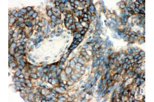 Anti- YB1 Picoband antibody,IHC(P) IHC(P): Human Lung Cancer Tissue (YBX1 antibody  (C-Term))