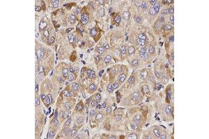 Immunohistochemistry of paraffin-embedded human liver cancer tissue using GAS2 antibody at dilution of 1:200 (x400 lens) (GAS2 antibody)