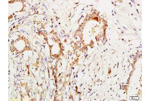 Formalin-fixed and paraffin embedded human breast cancer labeled with Anti-CA153/MUC1/KL-6 Polyclonal Antibody, Unconjugated  at 1:200 followed by conjugation to the secondary antibody and DAB staining. (MUC1 antibody  (AA 1101-1255))