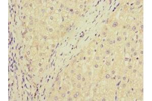 Immunohistochemistry of paraffin-embedded human liver cancer using ABIN7150741 at dilution of 1:100 (DUSP1 antibody  (AA 1-300))