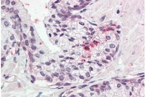 Human Prostate (formalin-fixed, paraffin-embedded) stained with KLK11 antibody ABIN337038 at 5 ug/ml followed by biotinylated goat anti-rabbit IgG secondary antibody ABIN481713, alkaline phosphatase-streptavidin and chromogen. (Kallikrein 11 antibody  (AA 68-82))
