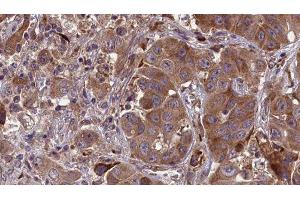 ABIN6277654 at 1/100 staining Human liver cancer tissue by IHC-P. (MLKL antibody  (Internal Region))