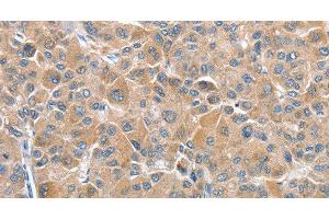 Immunohistochemistry of paraffin-embedded Human liver cancer tissue using CHMP4B Polyclonal Antibody at dilution 1:40 (CHMP4B antibody)