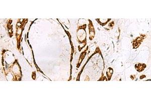 Immunohistochemistry of paraffin-embedded Human thyroid cancer tissue using GRWD1 Polyclonal Antibody at dilution of 1:55(x200) (GRWD1 antibody)