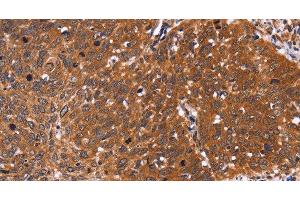 Immunohistochemistry of paraffin-embedded Human cervical cancer tissue using CDC37L1 Polyclonal Antibody at dilution 1:60