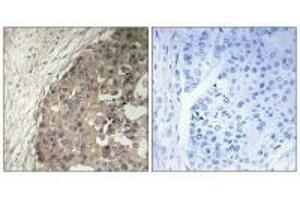 Immunohistochemistry analysis of paraffin-embedded human breast carcinoma tissue using CSGALNACT1 antibody. (CSGALNACT1 antibody)