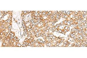 Immunohistochemistry of paraffin-embedded Human liver cancer tissue using NME4 Polyclonal Antibody at dilution of 1:45(x200) (NME4 antibody)