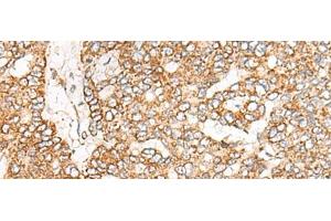 Immunohistochemistry of paraffin-embedded Human liver cancer tissue using NME4 Polyclonal Antibody at dilution of 1:45(x200)