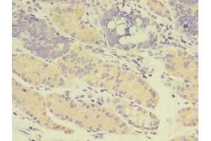 Immunohistochemistry of paraffin-embedded human gastric cancer using ABIN7166957 at dilution of 1:100 (GDI2 antibody  (AA 1-445))