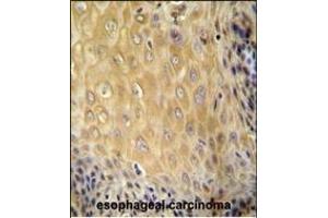 C6orf70 antibody (Center) (ABIN654987 and ABIN2844625) immunohistochemistry analysis in formalin fixed and paraffin embedded human esophageal carcinoma followed by peroxidase conjugation of the secondary antibody and DAB staining. (C6orf70 antibody  (AA 346-375))