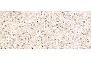 Immunohistochemistry of paraffin-embedded Human liver cancer tissue using ELP1 Polyclonal Antibody at dilution of 1:30(x200)