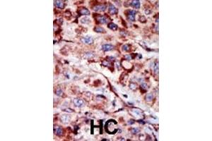 Formalin-fixed and paraffin-embedded human cancer tissue reacted with the primary antibody, which was peroxidase-conjugated to the secondary antibody, followed by AEC staining. (Adenylate Kinase 2 antibody  (C-Term))