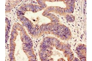 Immunohistochemistry of paraffin-embedded human colon cancer using ABIN7155869 at dilution of 1:100 (HIPK3 antibody  (AA 841-1130))