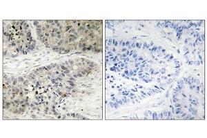 Immunohistochemistry analysis of paraffin-embedded human lung carcinoma tissue, using MAPK15 antibody. (MAPK15 antibody  (Internal Region))