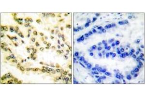 Immunohistochemistry analysis of paraffin-embedded human lung carcinoma tissue, using Lamin A (Cleaved-Asp230) Antibody. (Lamin A/C antibody  (Cleaved-Asp230))