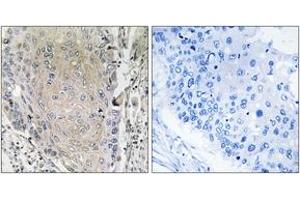 Immunohistochemistry analysis of paraffin-embedded human lung carcinoma tissue, using CBLN3 Antibody. (CBLN3 antibody  (AA 131-180))