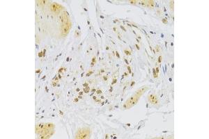 Immunohistochemistry of paraffin-embedded human stomach using Slug Antibody (ABIN6127298, ABIN6148181, ABIN6148183 and ABIN6217314) at dilution of 1:100 (40x lens).