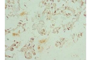 Immunohistochemistry of paraffin-embedded human bladder cancer using ABIN7148657 at dilution of 1:100 (CFDP1 antibody  (AA 1-299))