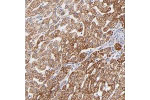 Immunohistochemical staining (Formalin-fixed paraffin-embedded sections) of human liver with TIMM8A polyclonal antibody  shows strong cytoplasmic positivity in hepatocytes. (TIMM8A/DDP antibody)
