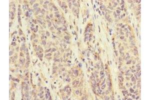 Immunohistochemistry of paraffin-embedded human ovarian cancer using ABIN7152671 at dilution of 1:100 (FCRL6 antibody  (AA 20-307))