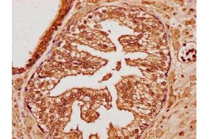 IHC image of ABIN7173475 diluted at 1:100 and staining in paraffin-embedded human endometrial cancer performed on a Leica BondTM system. (TRIM65 antibody  (AA 290-517))