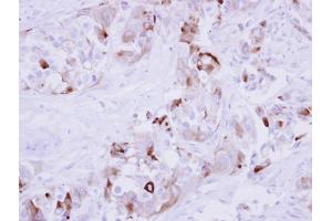 IHC-P Image Immunohistochemical analysis of paraffin-embedded human breast cancer, using MMP1, antibody at 1:250 dilution.