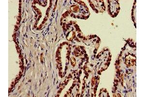 Immunohistochemistry of paraffin-embedded human prostate cancer using ABIN7170614 at dilution of 1:100 (DDX39B antibody  (AA 2-251))