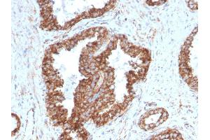 Formalin-fixed, paraffin-embedded human Prostate Carcinoma stained with PMEPA1 Mouse Monoclonal Antibody (PMEPA1/2698). (PMEPA1 antibody)