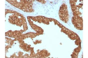 Formalin-fixed, paraffin-embedded human Prostate Carcinoma stained with RET Mouse Monoclonal Antibody (RET/2795). (Ret Proto-Oncogene antibody  (AA 702-848))