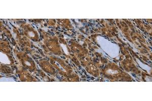 Immunohistochemistry of paraffin-embedded Human thyroid cancer using SMAD4 Polyclonal Antibody at dilution of 1/40 (SMAD4 antibody)