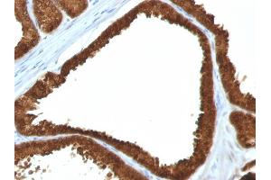 Formalin-fixed, paraffin-embedded human Colon Carcinoma stained with IDH1 Mouse Monoclonal Antibody (IDH1/1152). (IDH1 antibody  (AA 281-414))