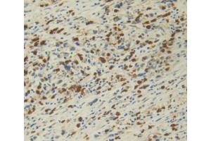 DAB staining on IHC-P; Samples: Human Stomach Cancer Tissue. (IL12A antibody  (AA 23-219))