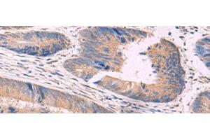 Immunohistochemistry of paraffin-embedded Human colorectal cancer tissue using NIPSNAP1 Polyclonal Antibody at dilution of 1:50(x200) (NIPSNAP1 antibody)