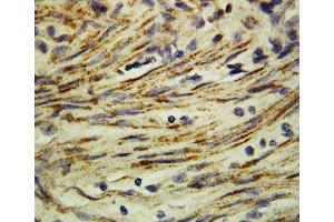 Anti-MMP16 antibody, IHC(P) IHC(P): Human Rectal Cancer Tissue (MMP16 antibody  (C-Term))
